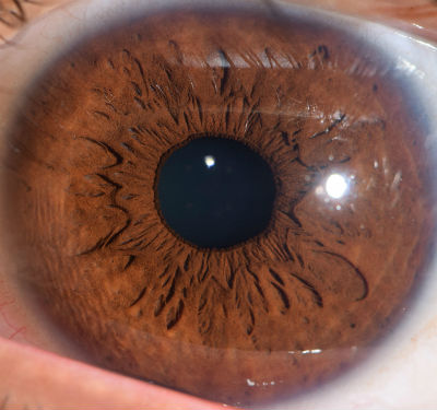 Lymphatic-iris-blue #1